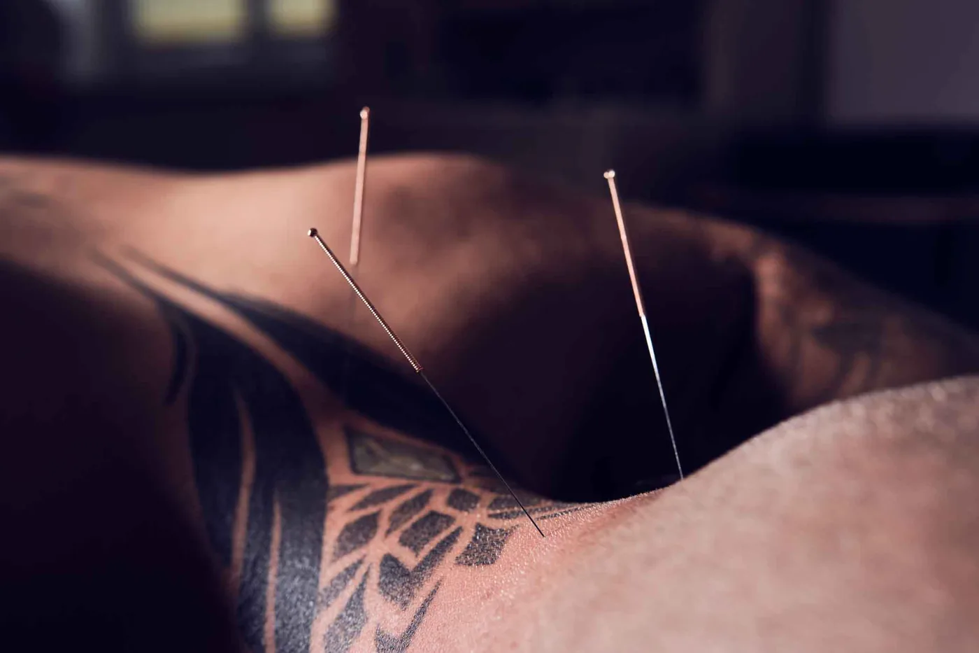 Drei feine Akupunkturnadeln im Schulter-Nacken-Bereich eines Patienten in Bauchlage