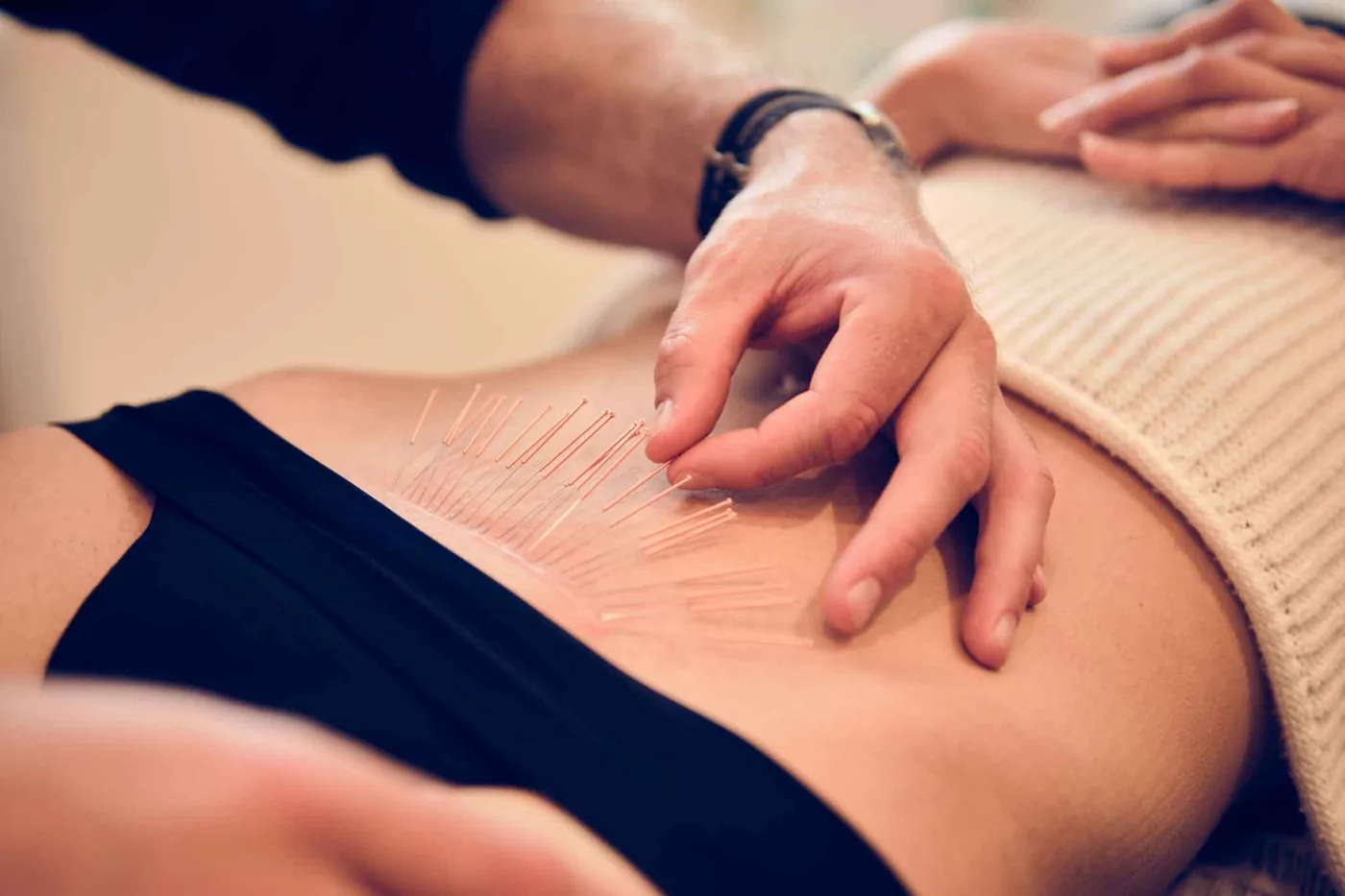 Eine Reihe feiner Akupunkturnadeln am Unterbauch, daneben tastet die Hand des Behandlers